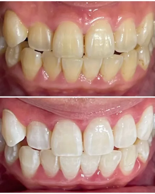 Deep Self-Whitening with 40-Minute Irradiation and Local English Map 105 Minutes